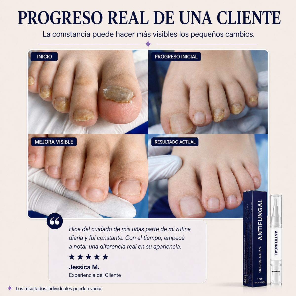 Elarumi™ Pluma Antimicótica para Uñas