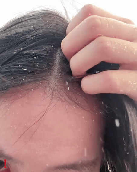 Visible Flakes Don’t Mean You’re Dirty — You Just Haven’t Found the Right Shampoo Yet.