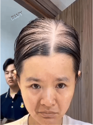 You Can’t Hide Thinning Hair Under a Hat Forever.
