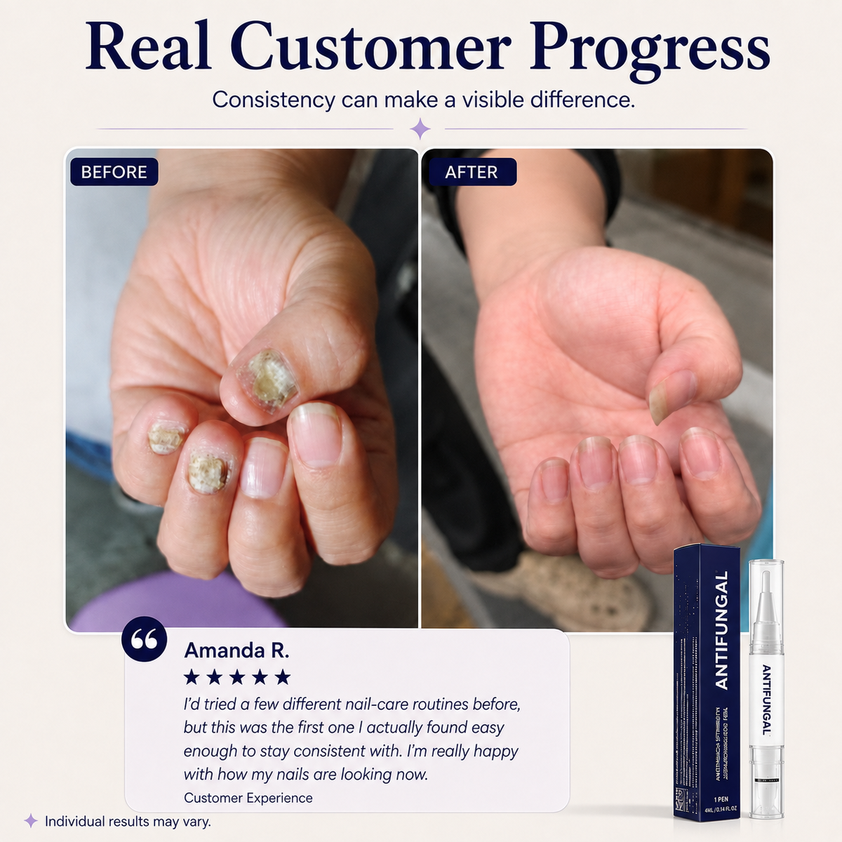 Elarumi™ Antifungal Pen